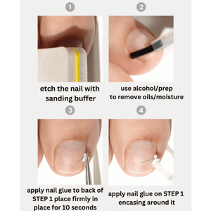 DGEL Corrector for Ingrown Nails