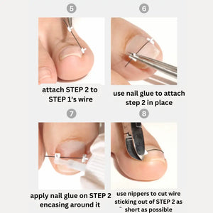 DGEL Corrector for Ingrown Nails